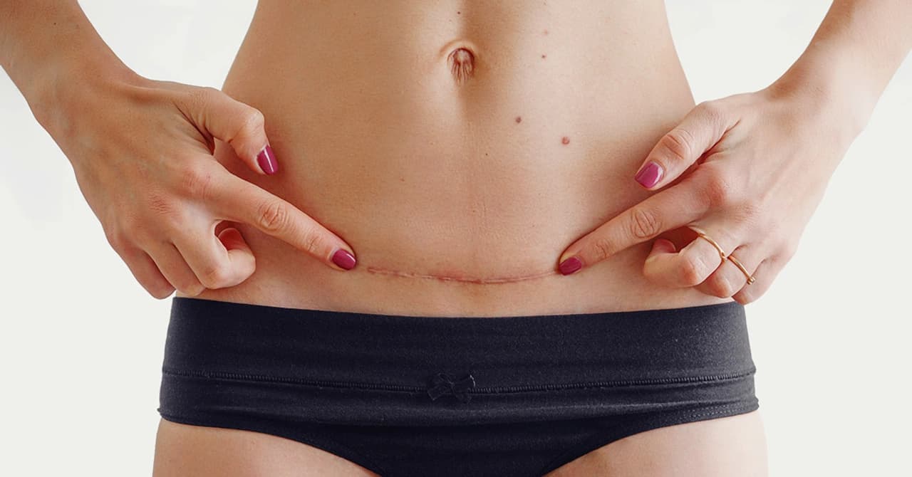 Tummy Tuck Scar