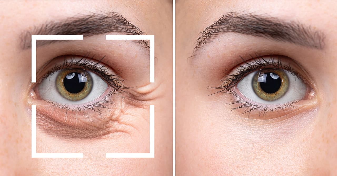 Eyelid Surgery Laser