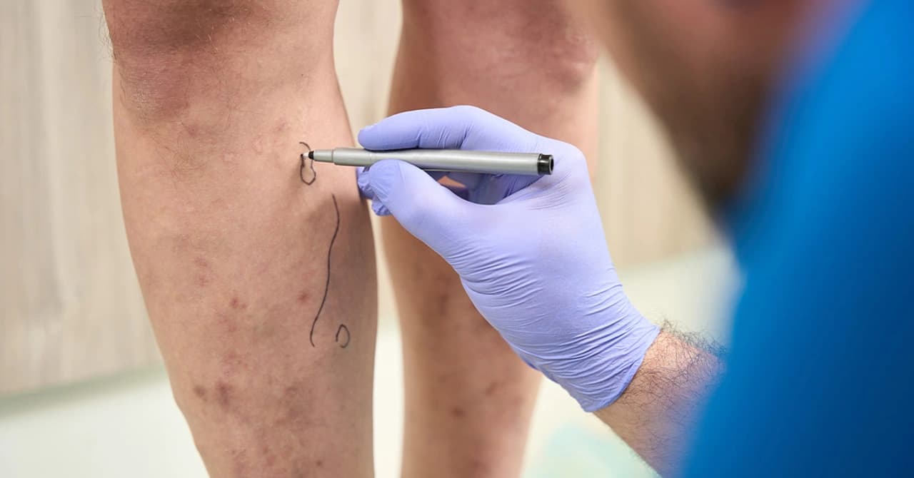 Removing Varicose Veins