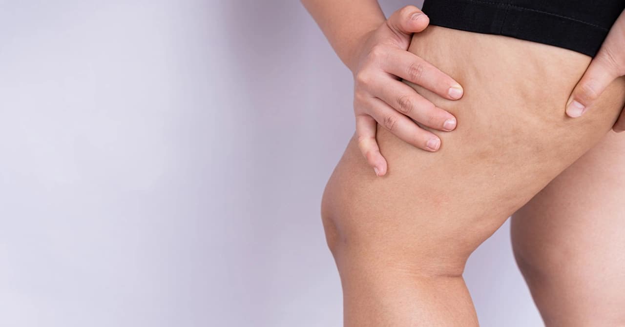 What is Lipedema?