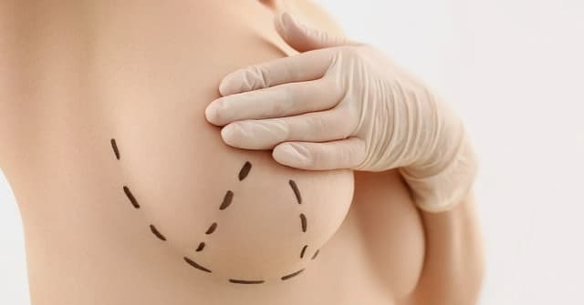 Breast Lift