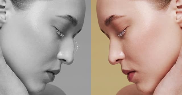 Turkey Nose Jobs