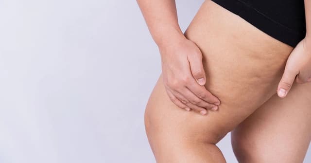 Lipedema Treatment