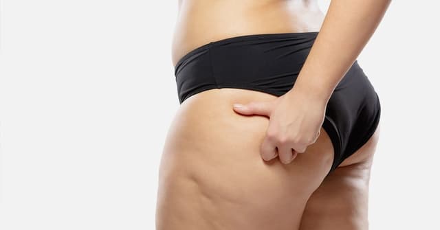 Lipedema Symptoms