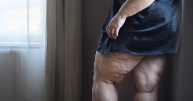 Lipedema vs. Obesity