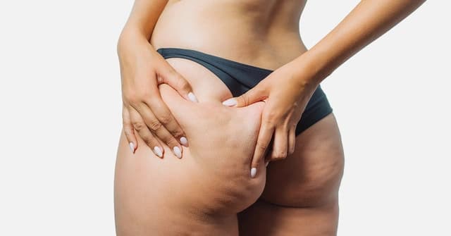 Lipedema vs. Cellulite
