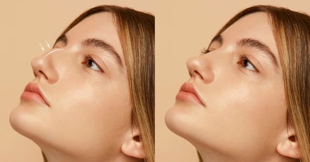 Septorhinoplasty