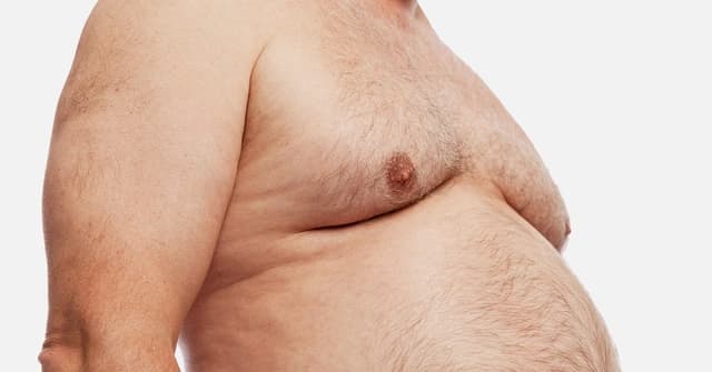 Gynecomastia vs Fat