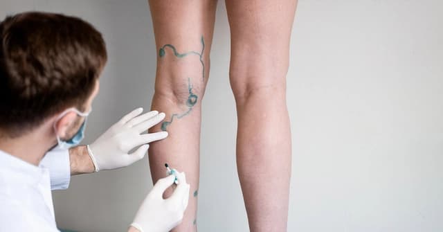 Sclerotherapy