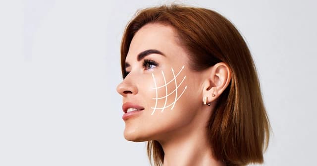 Facelift