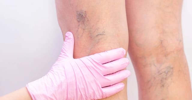 Varicose Veins
