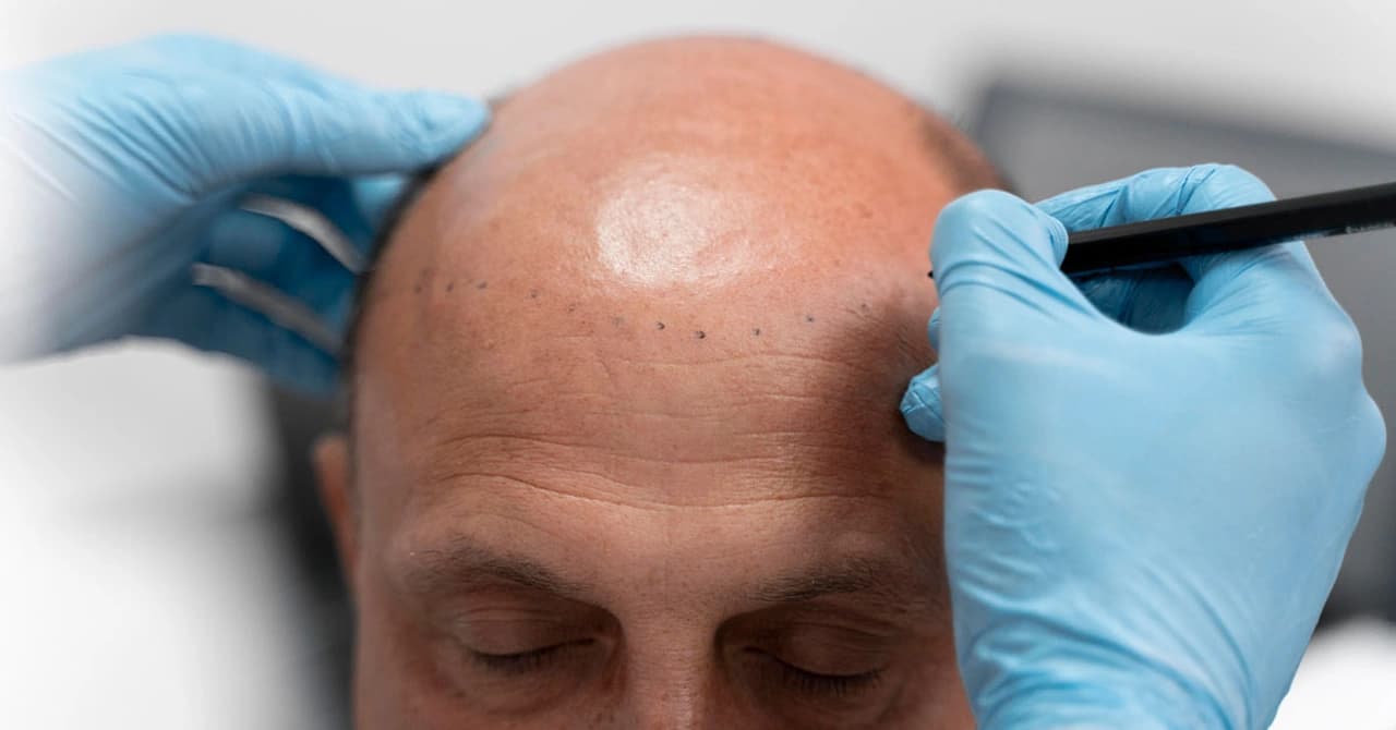 FUE Technique Hair Transplant in Turkey​