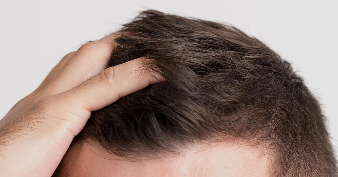 FUE Hair Transplant Effectiveness