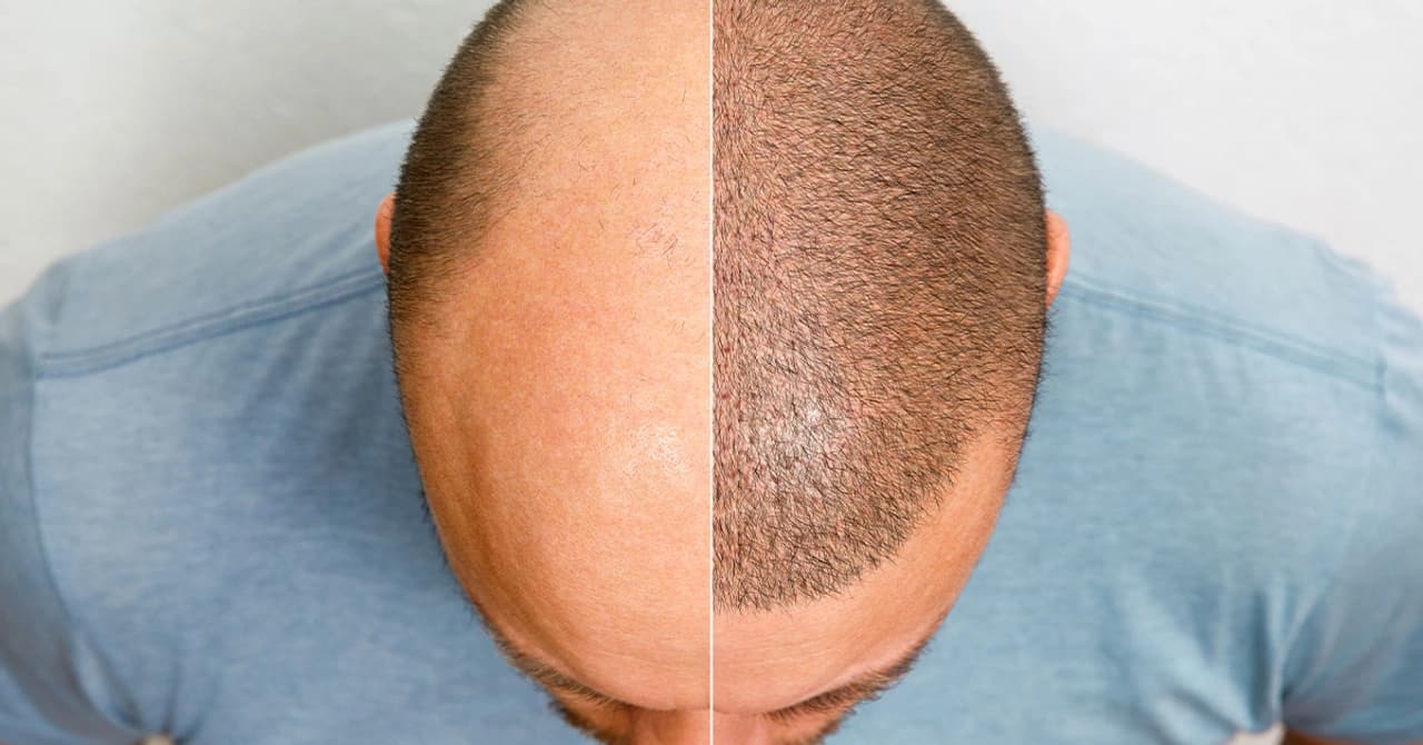 FUE Hair Transplantation Recovery