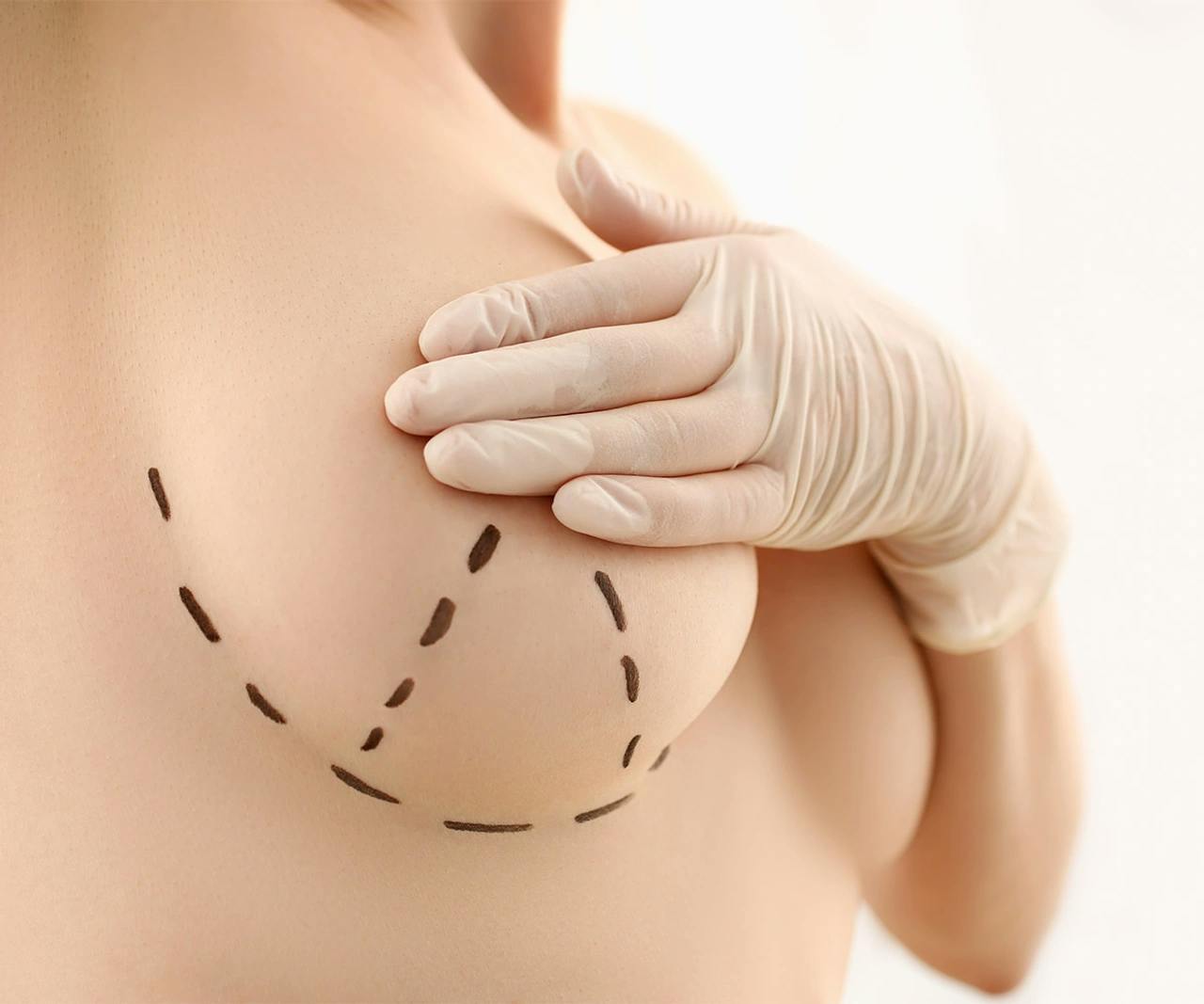 Breast Lift Surgery in Turkey