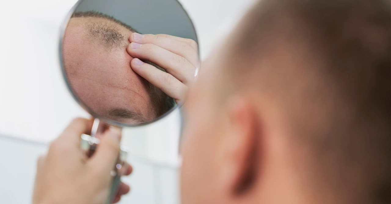 Still Losing Hair? What May Be the Reasons?