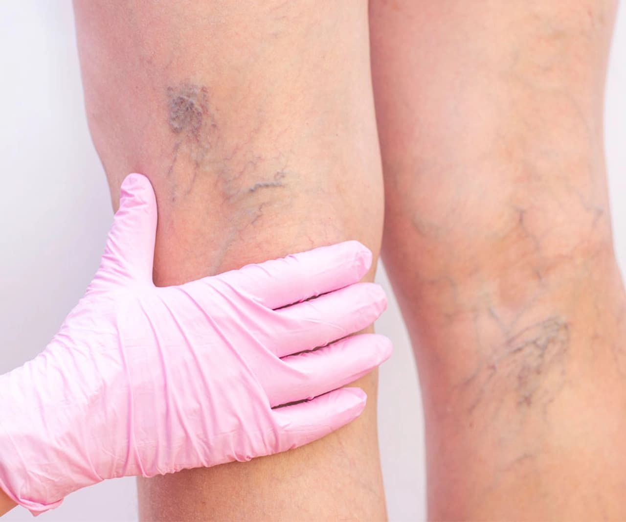 Preparing for Aesthetic Varicose Vein Treatment