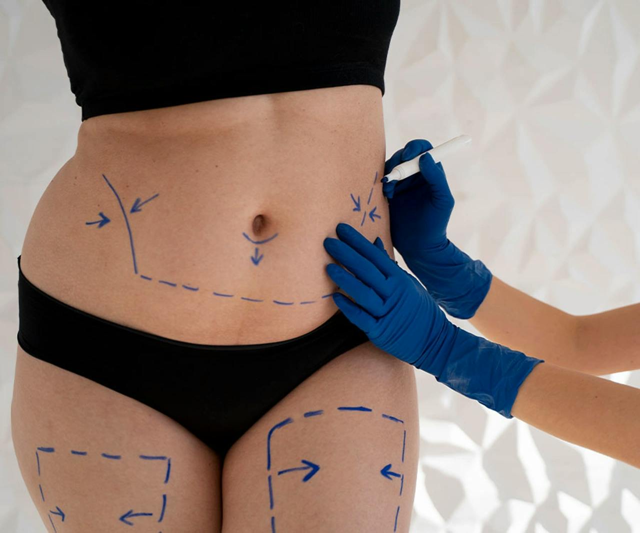 Liposuction in Turkey