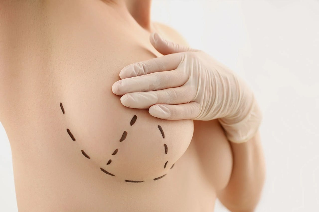 Breast Lift Surgery (Breast Uplift) in Turkey