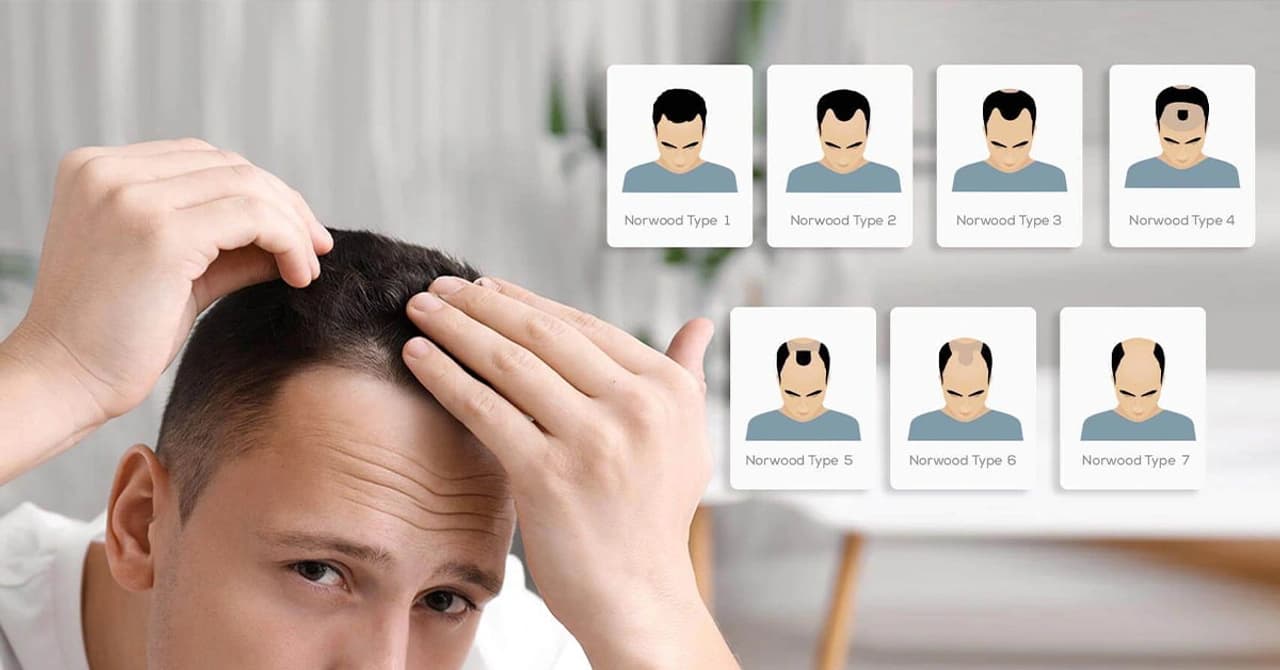 Hair Transplant Norwood Scale​