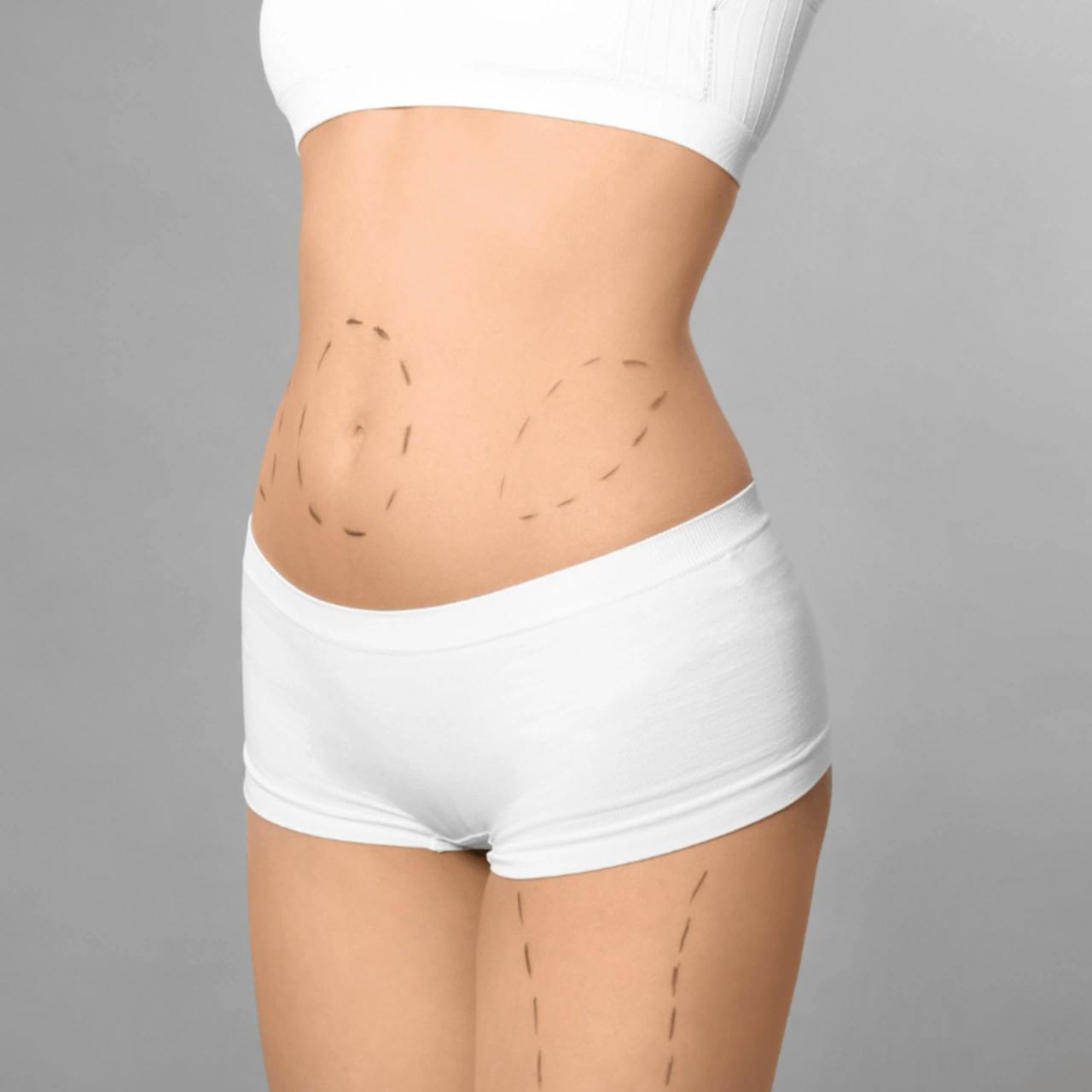 What is a Tummy Tuck?