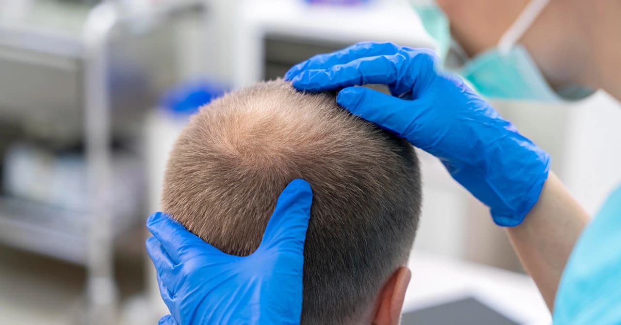 Hair Transplant Recovery Process