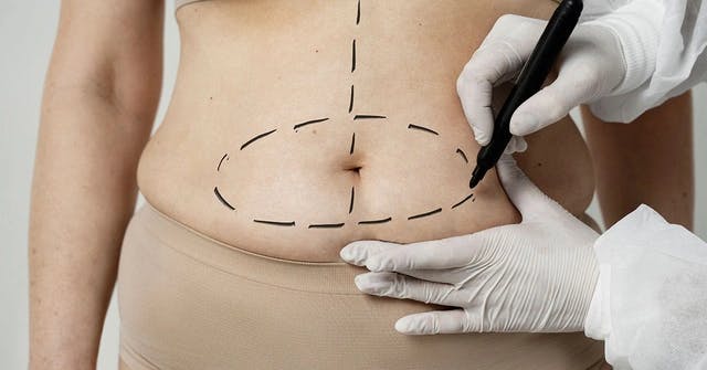 Why Opt for Tummy Tuck Surgery in Turkey​