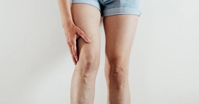 When to Worry About Varicose Veins