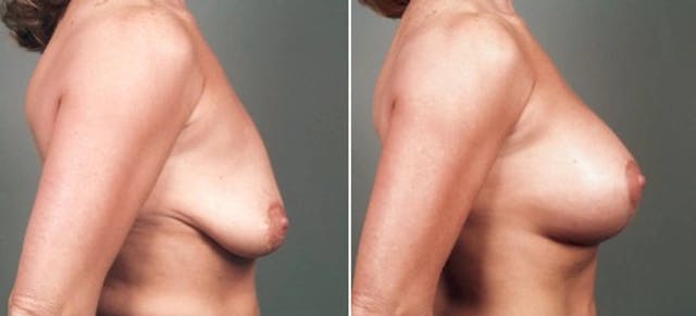 Sag Breast and Breast Uplift Surgery​