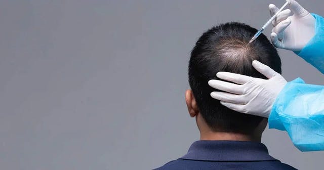 How Long Do Hair Transplants Last?