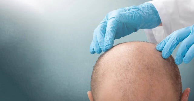 Hair Transplant Costs in the UK