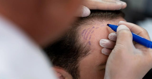 Hair-Loss and FUE Technique​