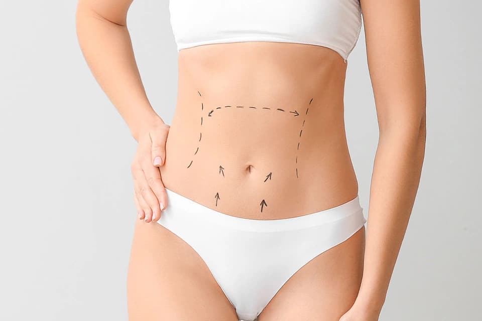 Tummy Tuck (Abdominoplasty) in Turkey